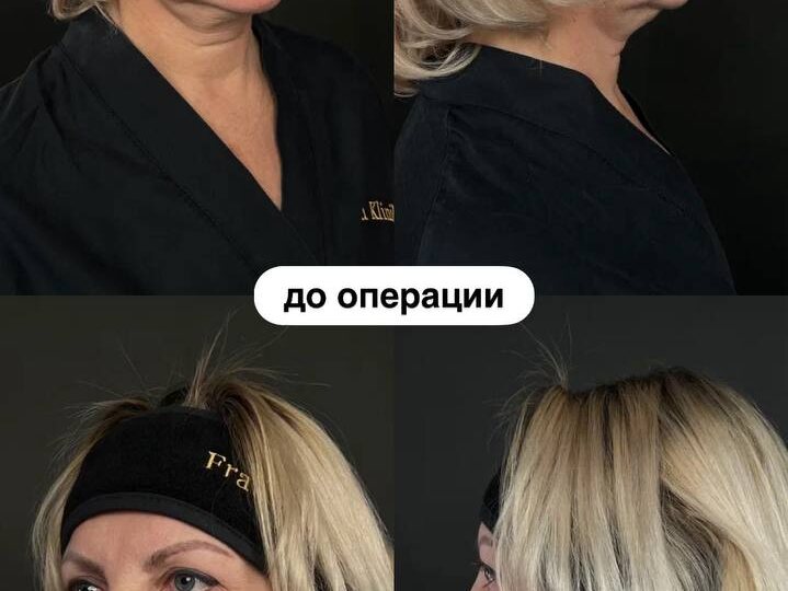 2,5 года после фейслифтинга и нижней блефаропластики