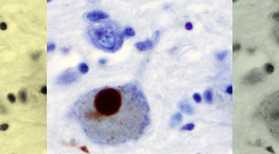   N + 1; Daniele Urso et al. / JAMA Neurology, 2026