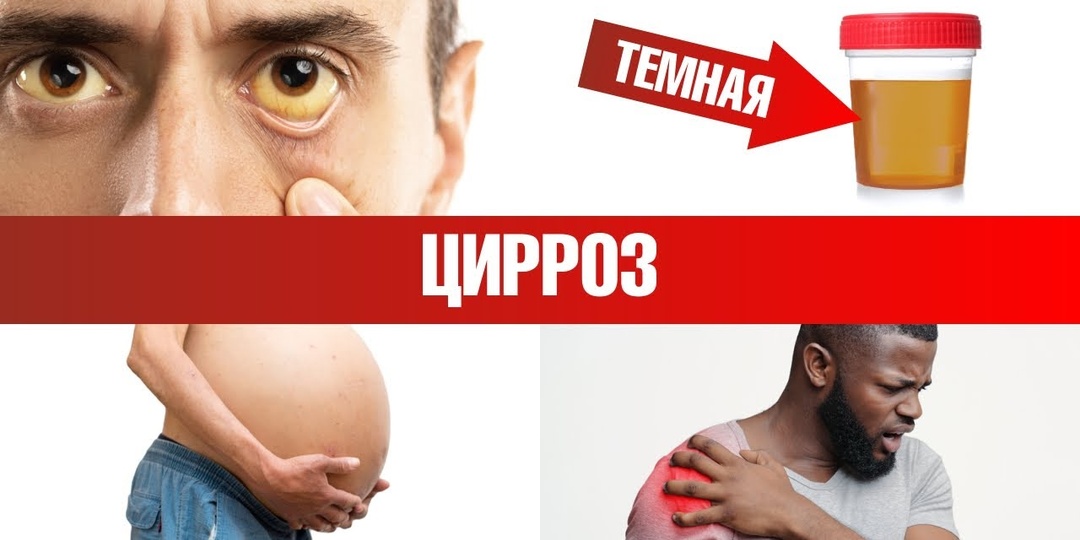 12 ранних признаков Цирроза печени, которые требуют особого внимания со стороны врачей