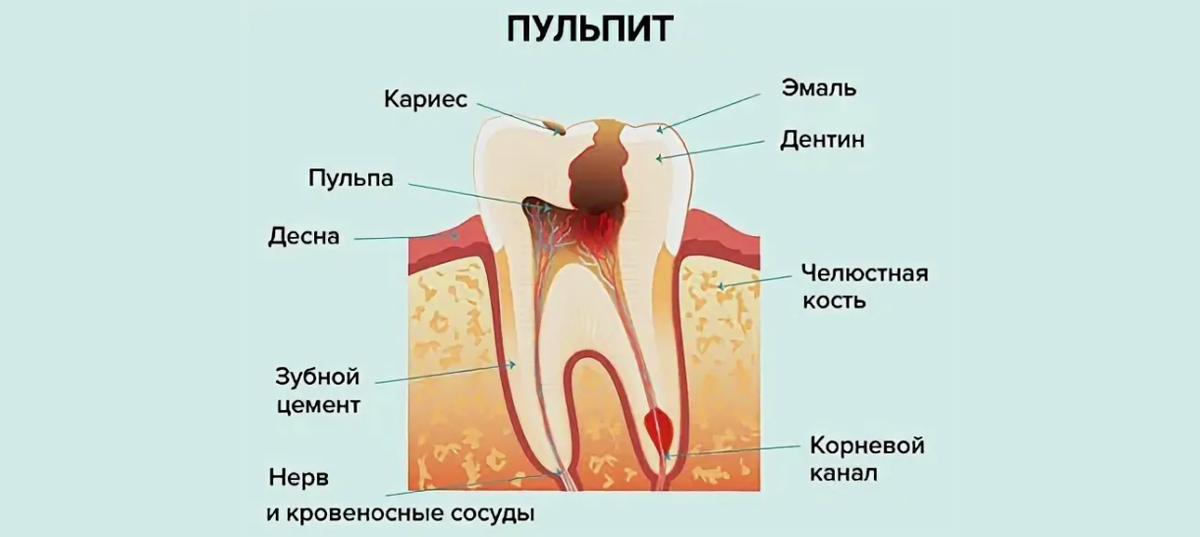Глубокий кариес и пульпит