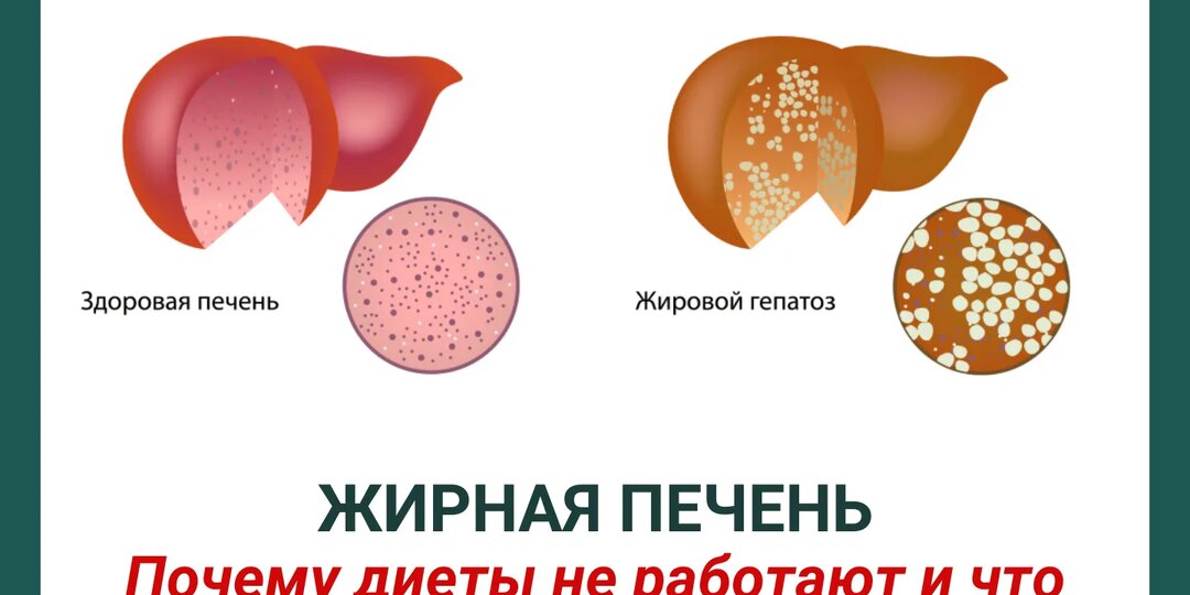 «Жирная печень: почему диеты не работают и что реально помогает»