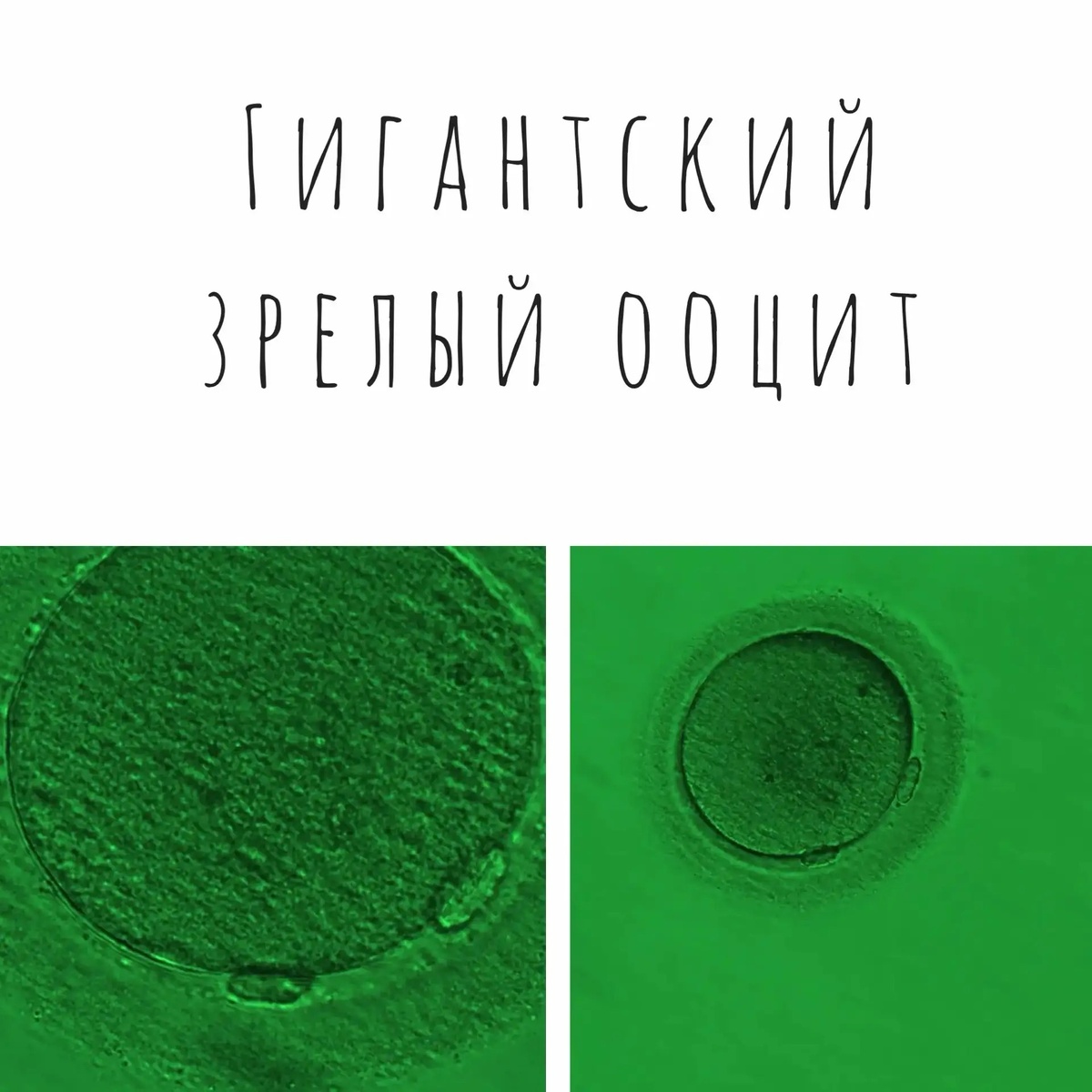 Аномальный ооцит