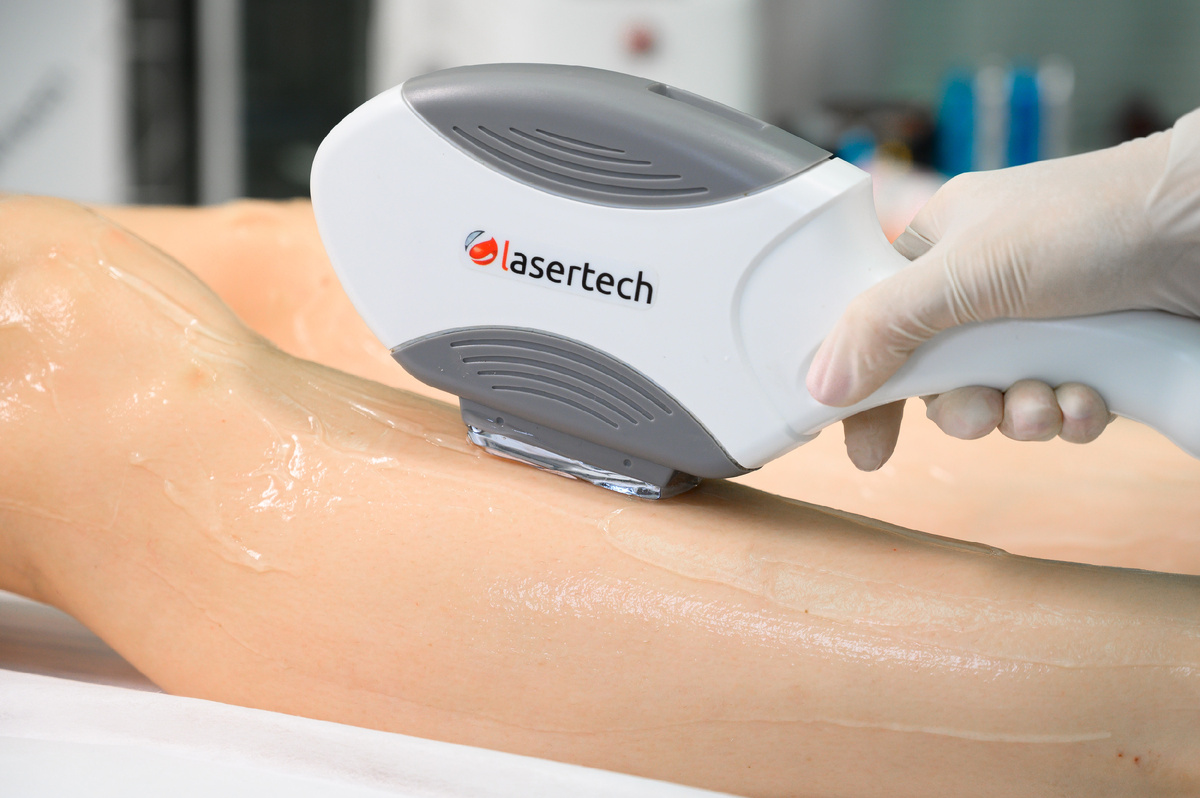Эпиляция темных, светлых, пушковых волос на аппарате Lasertech ELFA | ELOS