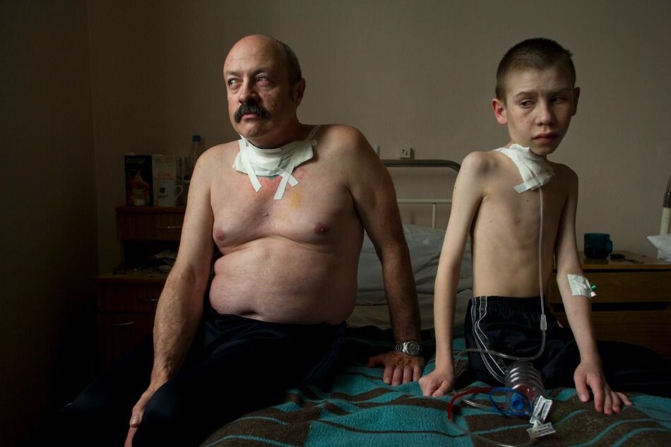 Я назвал это фото - "Двое". 54-летний Олег Шапиро и 13-летний Дима Богданович в больнице Минска после операции на щитовидной железе. "Йодный удар" радиоактивным йодом-131, обрушившийся на население в первые недели аварии. Фото из книги-фотоальбома Герда Людвига "Длинная Тень Чернобыля". Предисловие к книге написал М.С.Горбачев. Тот случай, когда один в инфополе - воин или "и не друг, и не враг – а так…"
