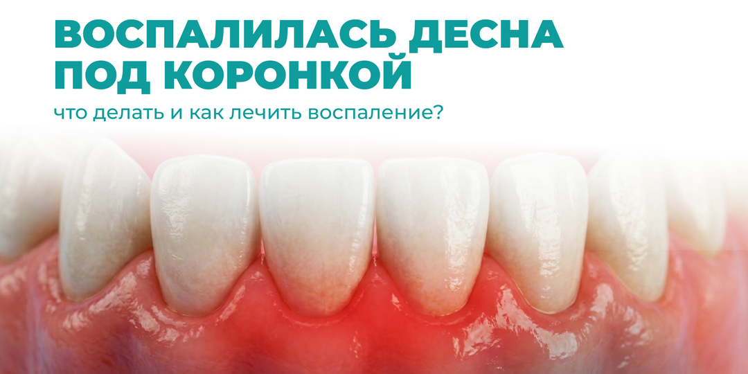 Что делать, если воспалилась десна под коронкой?