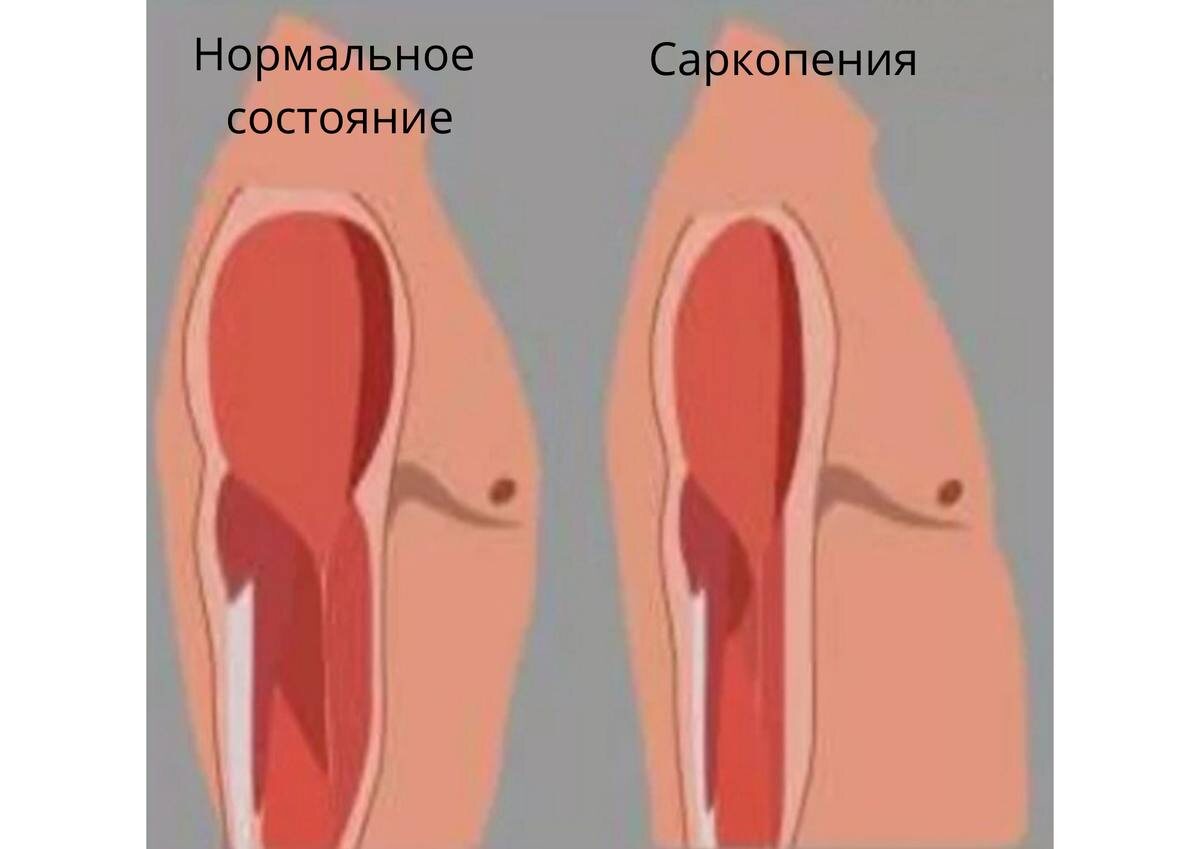 Нормальное состояние мышечной массы и потеря мышц
