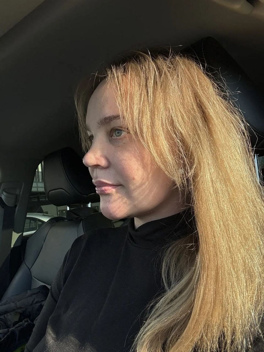 1 месяц после комплексного омоложения лица. Пластический хирург Остринская Т.В.