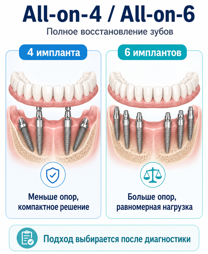4 или 6 имплантов – врач определяет после диагностики