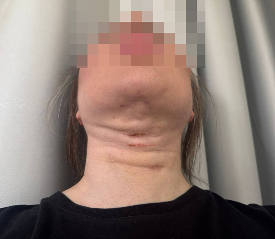 Фото: из личного архива Евгении Шомовой
Евгения Шомова после хирургического вмешательства