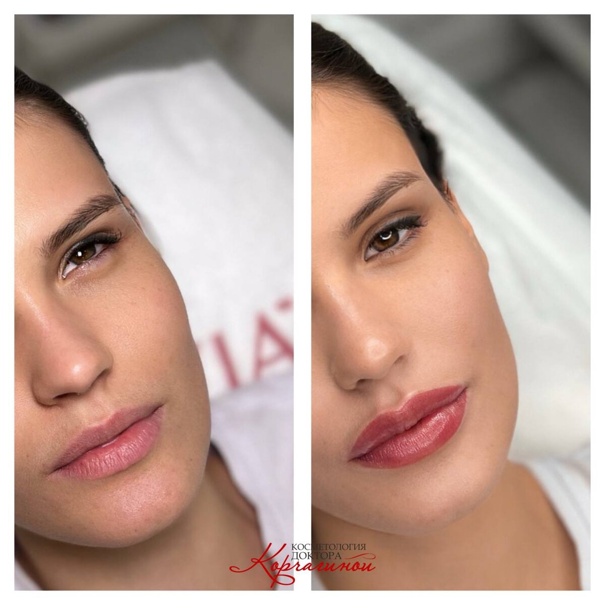 Результат увеличения губ . 