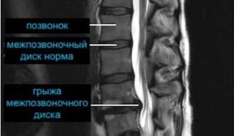 МРТ поясничного отдела позвоночника
