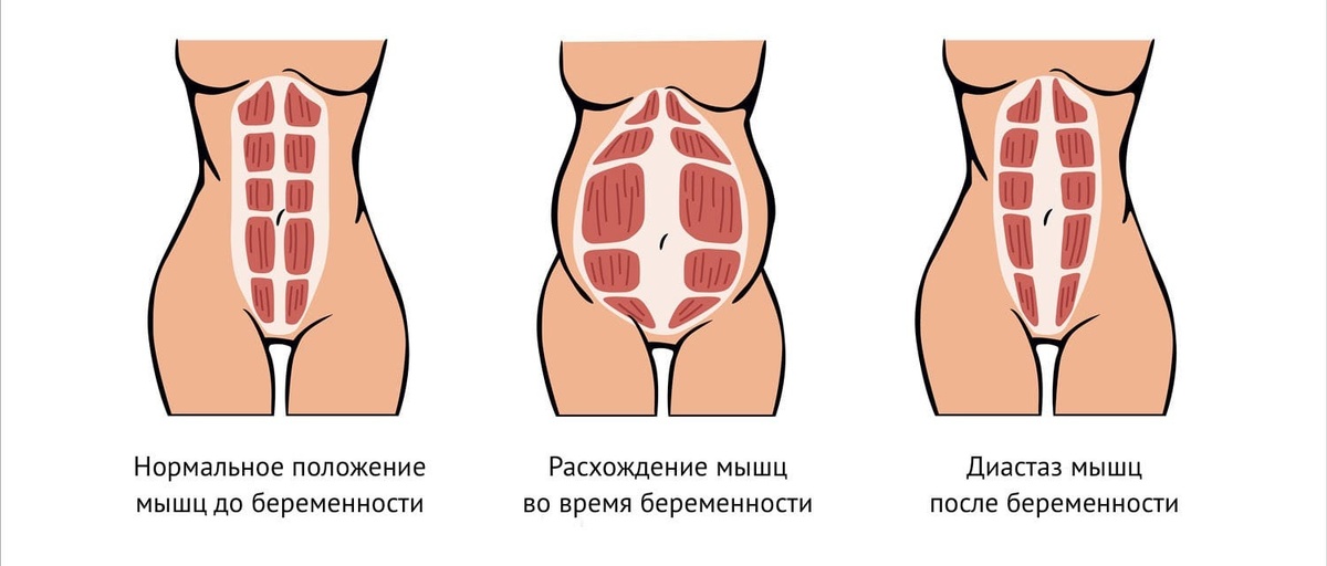 Диастаз после родов. Источник: https://www.onclinic.ru/kak-vernut-ploskiy-zhivot-posle-rodov/