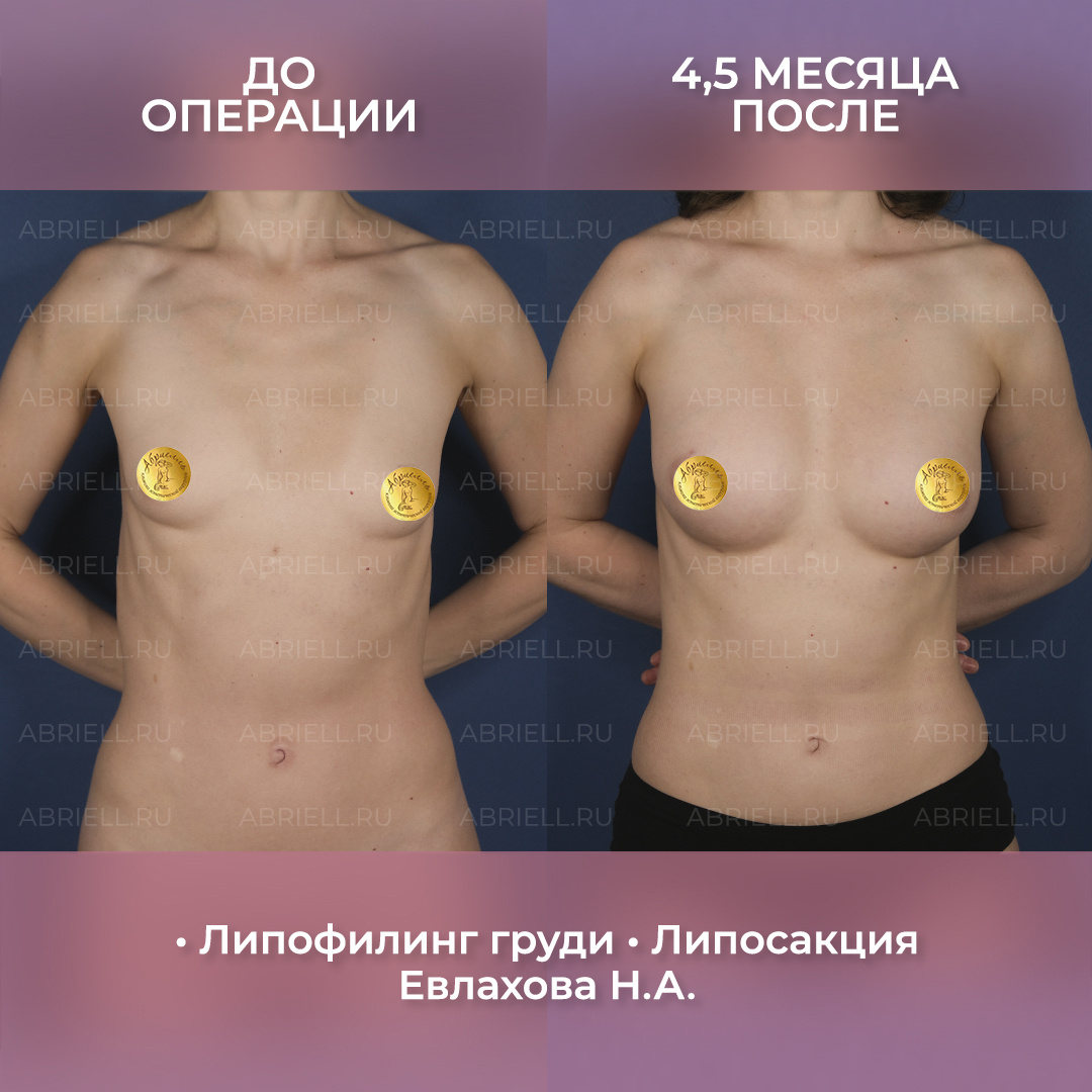 Евлахова Наталья Алексеевна Пластический хирург в Санкт-Петербурге клиника Абриелль. Липофилинг груди - увеличение груди сосбственным жиром без имплантов / Результат до и после операции 