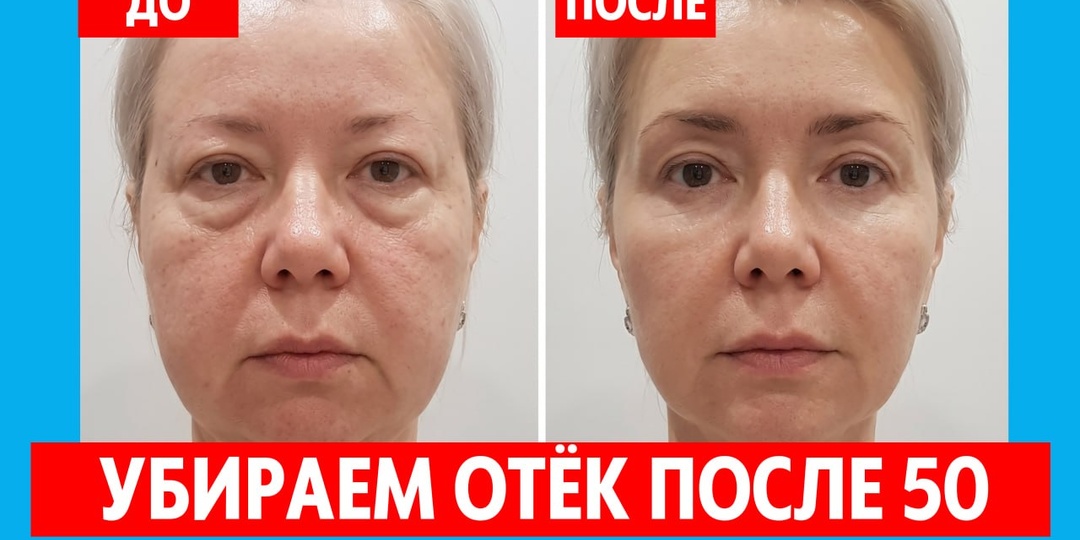 Застой лимфы: как распознать и устранить. Расширенный гид из 11 проверенных советов