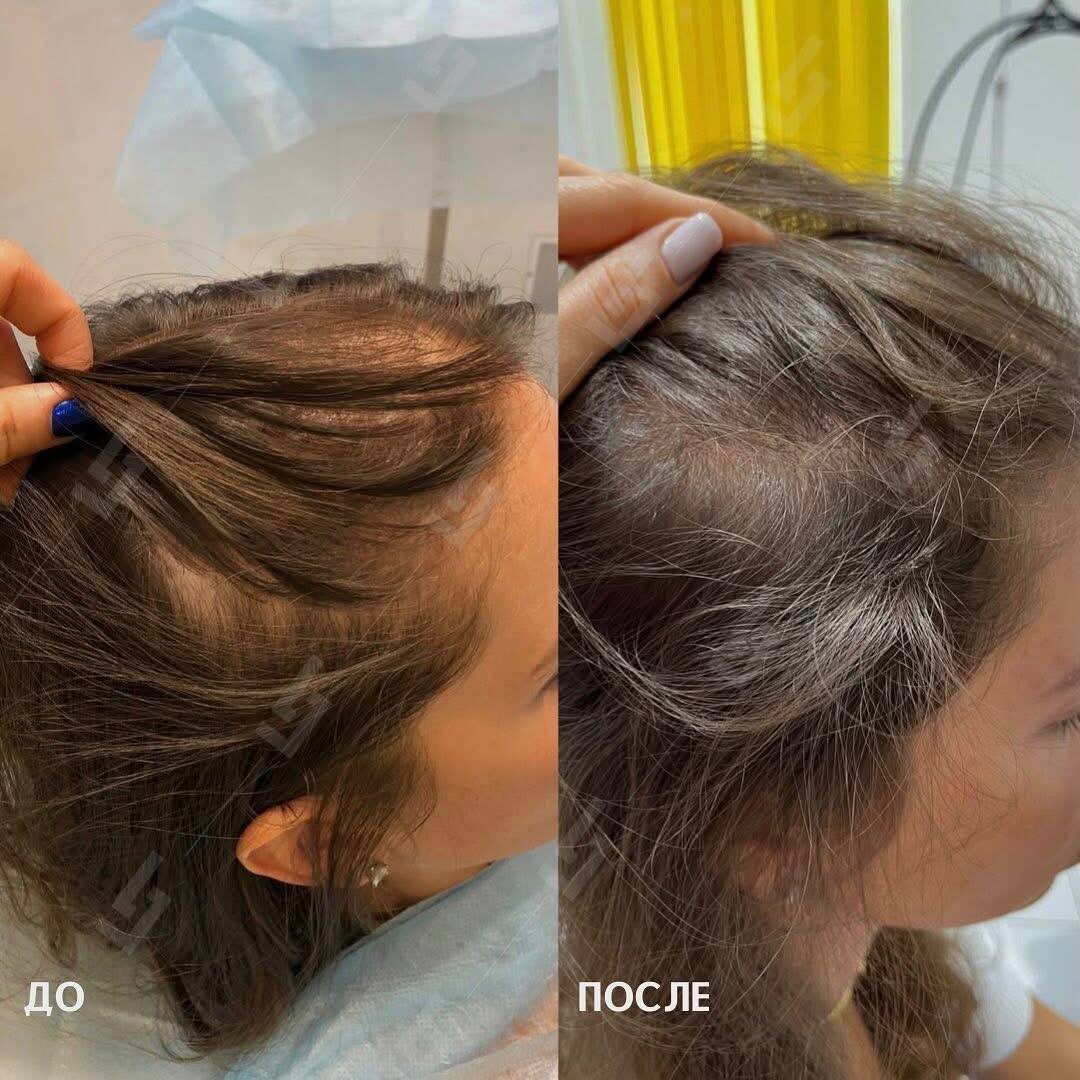 Эффект после процедуры Regenera Activa