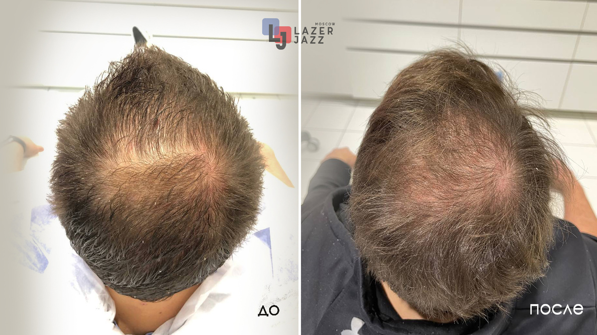 Эффект после процедуры Regenera Activa