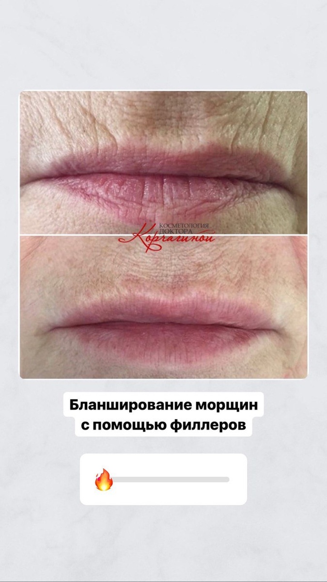 Результат коррекции кисетных морщин . 