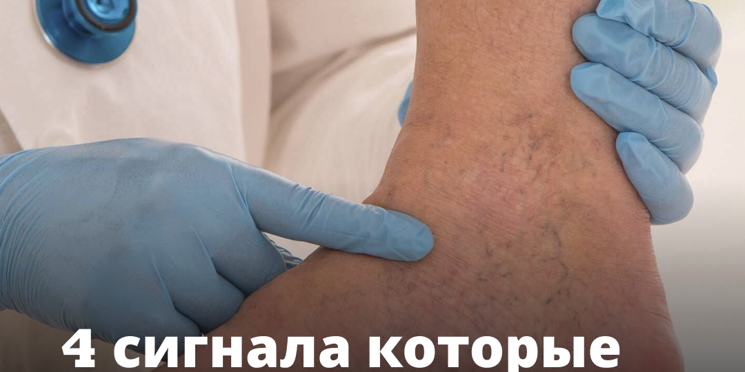 4 сигнала в ногах, которые предупреждают о скрытом тромбозе