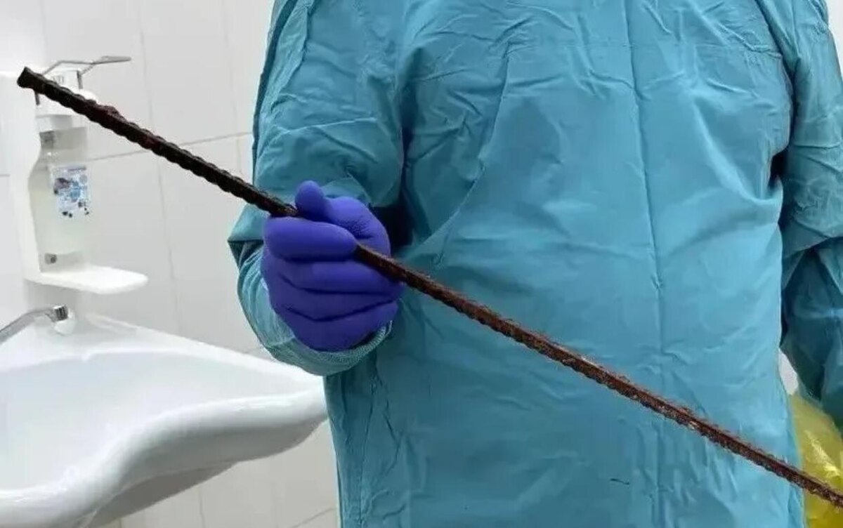   Хирурги в Ижевске извлекли арматуру из груди пациента