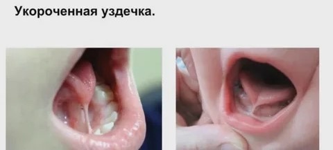 Короткая уздечка языка: стоматолог говорит «резать», логопед — «тянуть». Как уздечка под языком управляет всем телом.