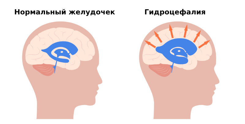 https://fnkc-fmba.ru/zabolevaniya/gidrotsefaliya/