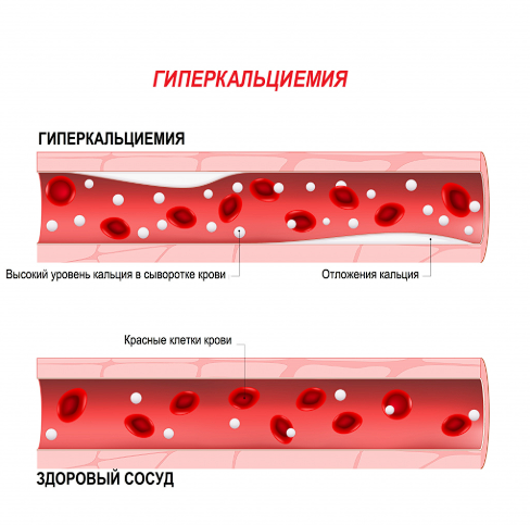 Гиперкальциемия. Источник: invitro.ru