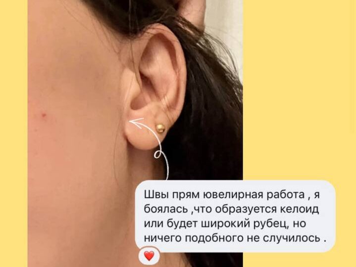«А шрамы будут видны?» – один из самых частых страхов перед пластической операцией