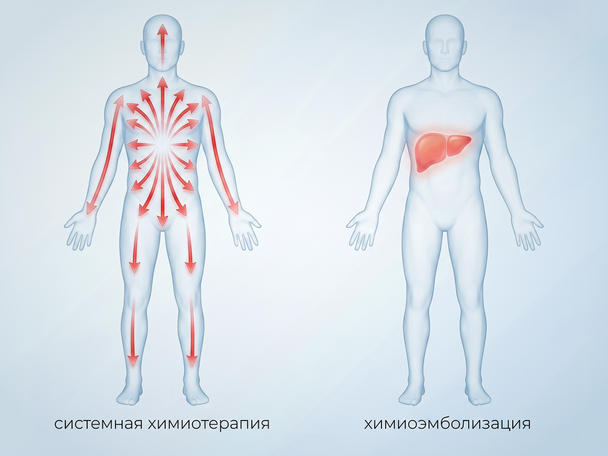 Принципиальное отличие методики — при химиоэмболизации концентрация лекарственного воздействия в строго определенной зоне
