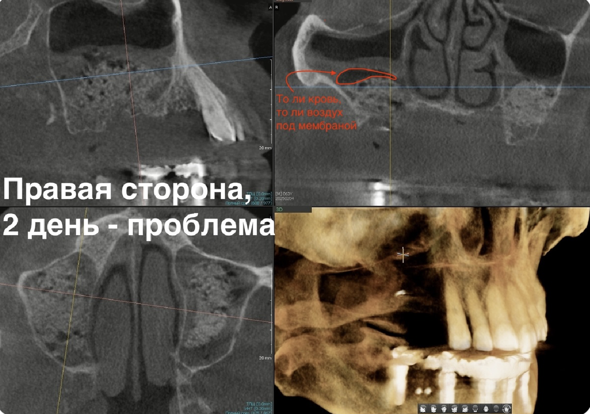 Разрегметизация синус-лифтинга, февраль 2025