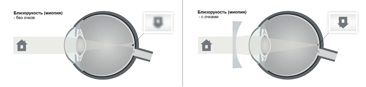 Близорукость, миопия (Татьяна Шефер)