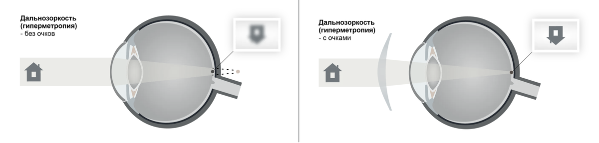  Дальнозоркость, гиперметропия (Татьяна Шефер)