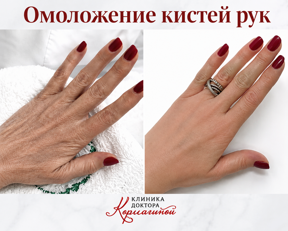 Результат омоложения рук 
