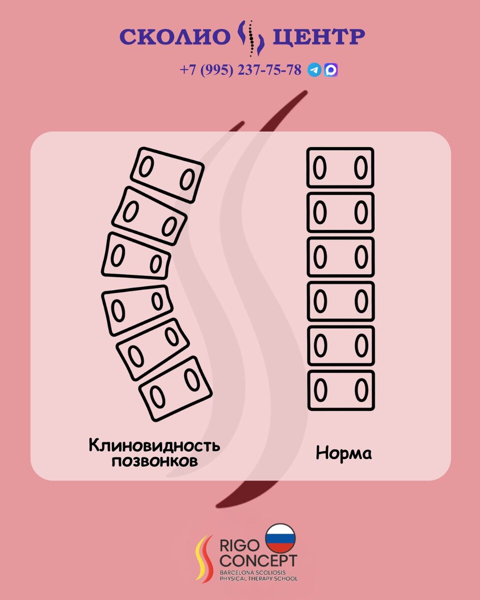Клиновидность позвонков в результате сколиотической деформации