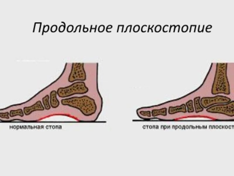 Свод стопы становится ниже, подошвенная фасция (плотная связка под кожей от пятки до пальцев) натягивается сильнее