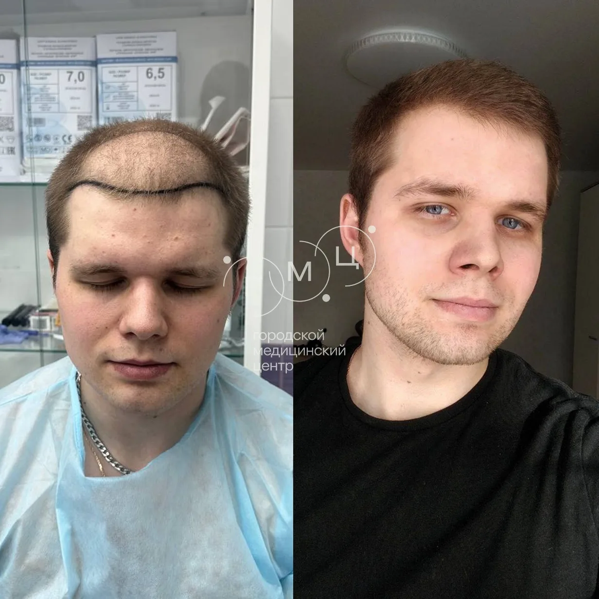 Пересадка волос в клинике ГМЦ