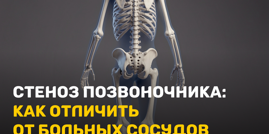 Стеноз позвоночника: как отличить от больных сосудов