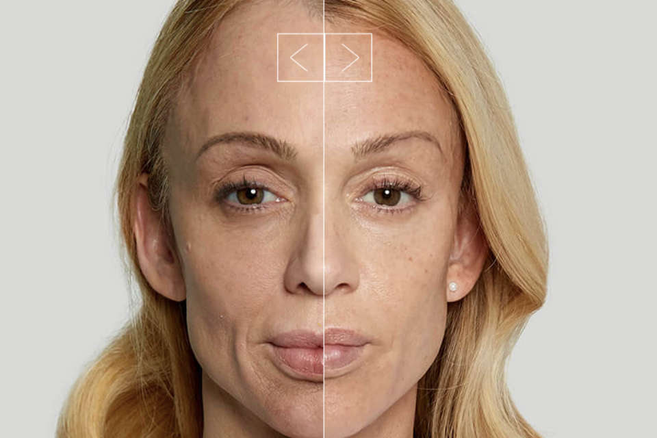 Эффект Sculptra разворачивается постепенно: первые изменения ощущаются через 4–6 недель, визуальный результат — через 2–3 месяца, полный эффект формируется к 6 месяцам и сохраняется до 2 лет.