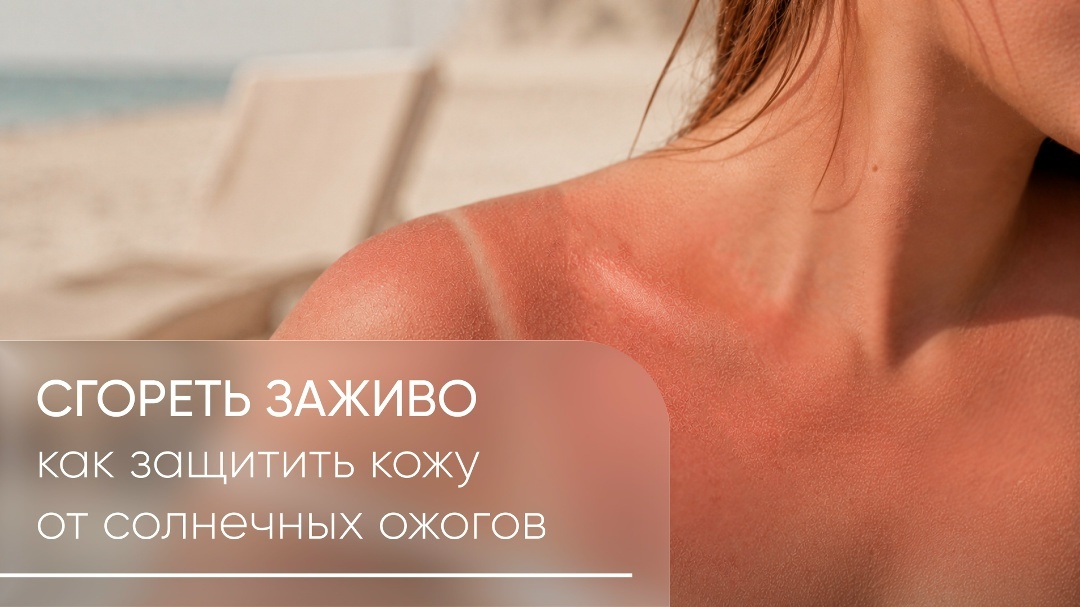Как защитить кожу от солнечных ожогов