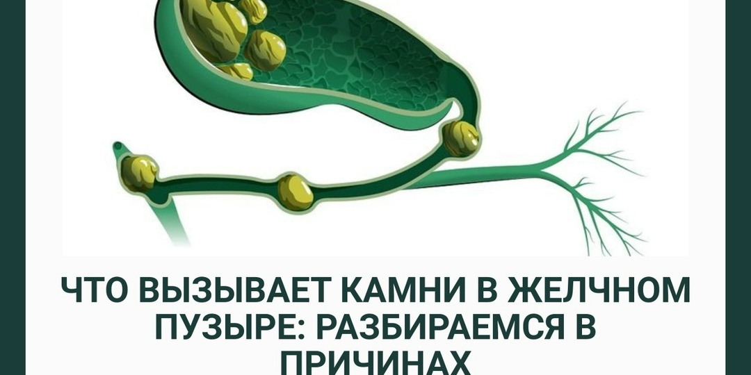 Что вызывает камни в желчном пузыре: разбираем причины