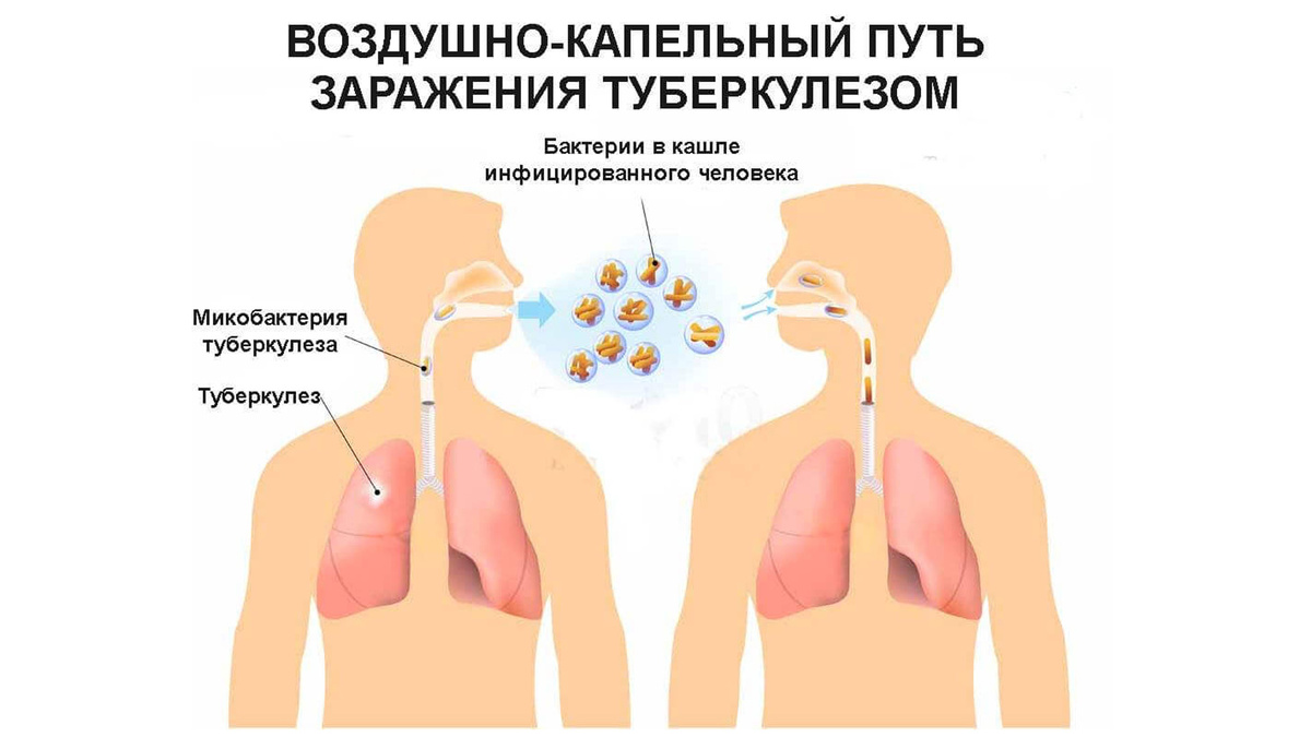 как заражаются туберкулёзом