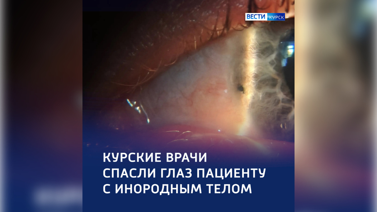    Курские офтальмологи сохранили зрение пациенту с инородным телом в глазном яблоке