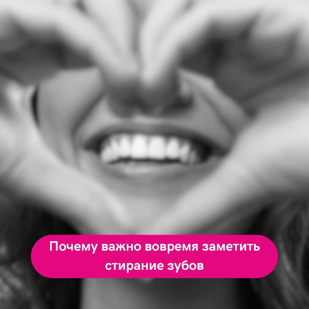 Почему важно вовремя заметить стирание зубов