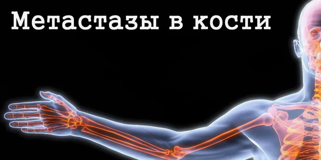 Метастазы в кости: стоит ли отчаиваться?