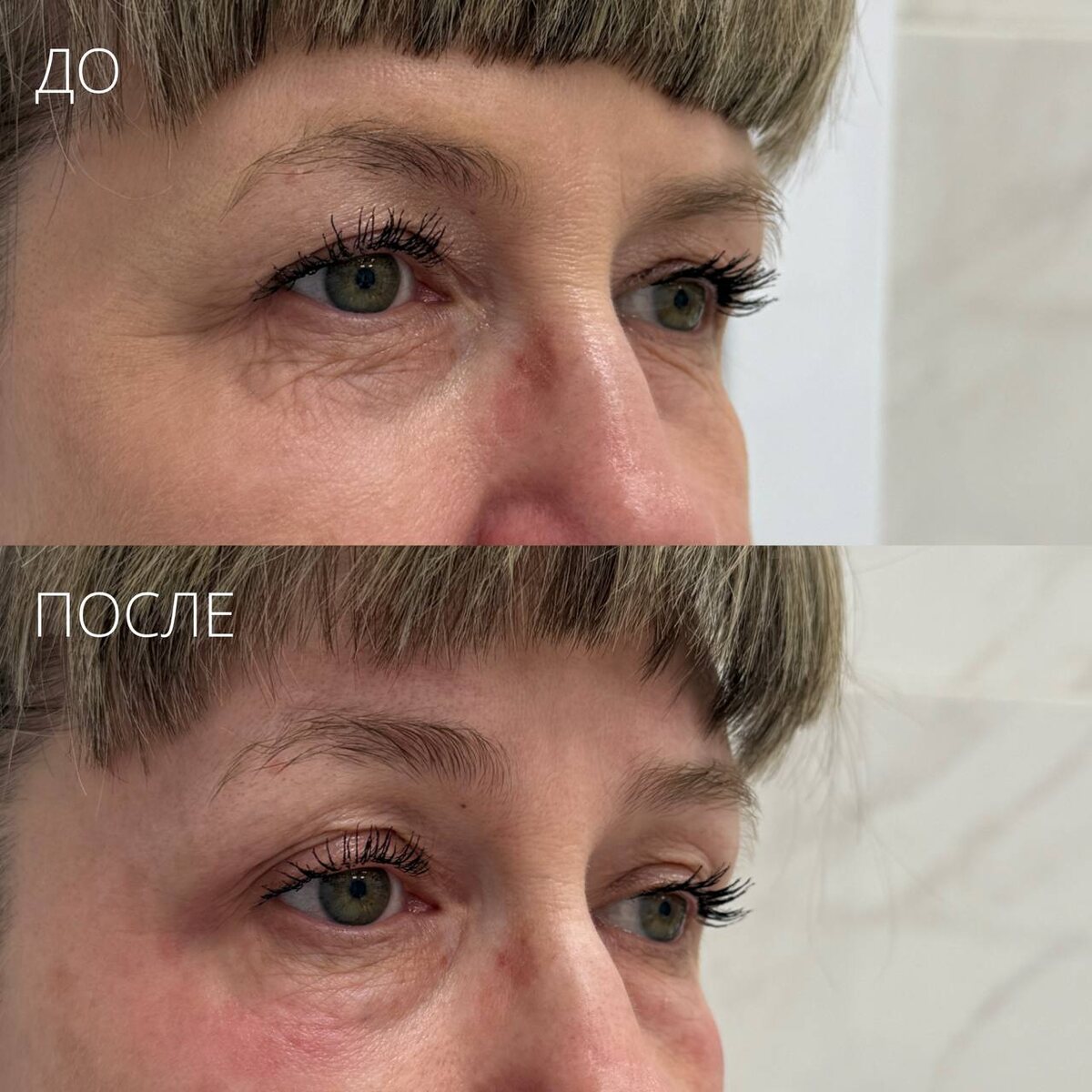 Безоперационная блефаропластика Oligio