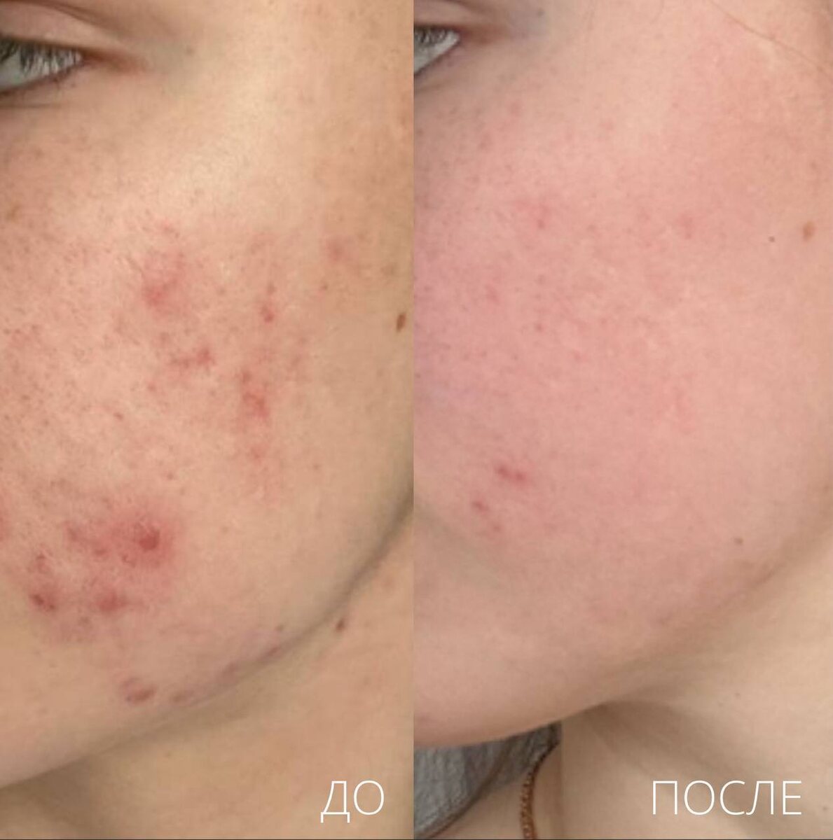 Результаты после лечения акне