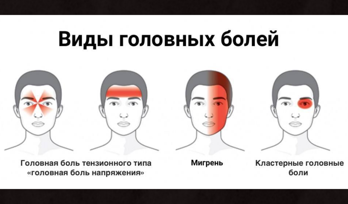 Виды головной боли