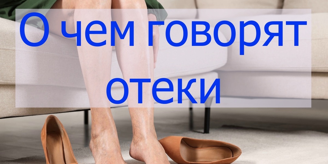 О чем могут говорить отеки.