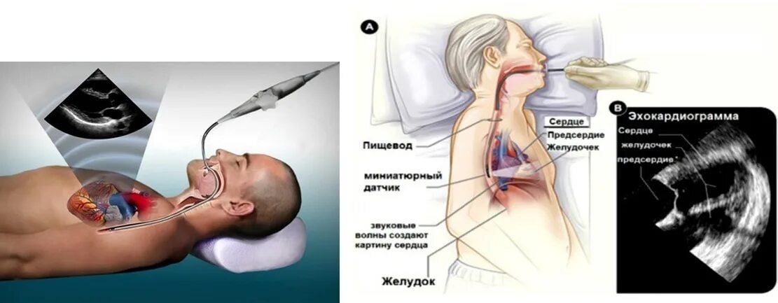 чреспищеводной ЭхоКГ