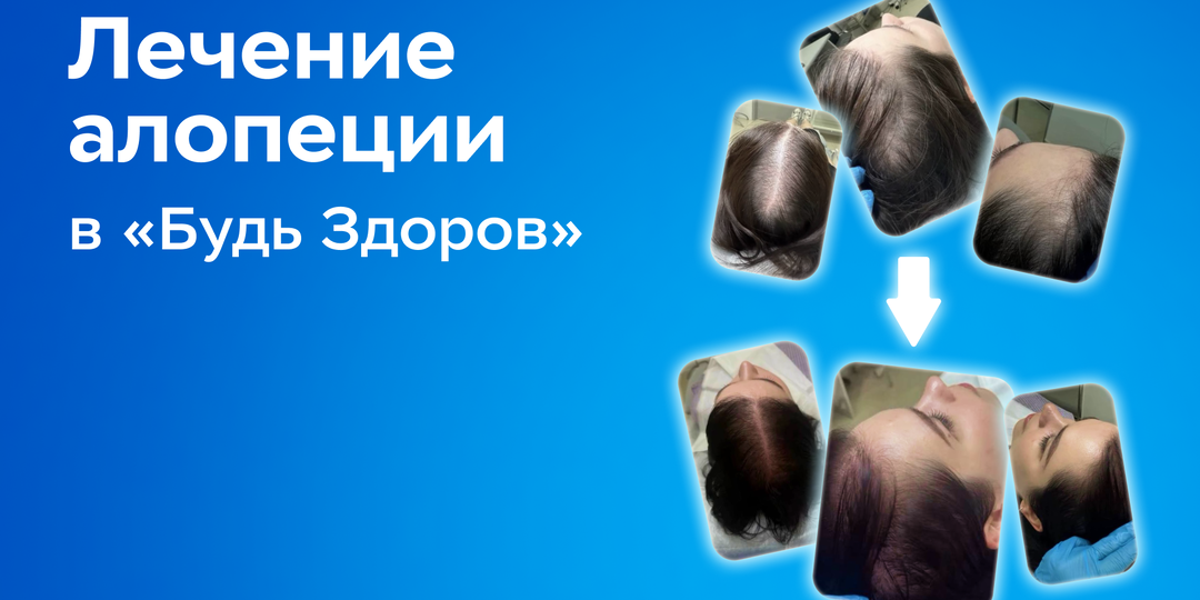 Лечение алопеции в «Будь Здоров»