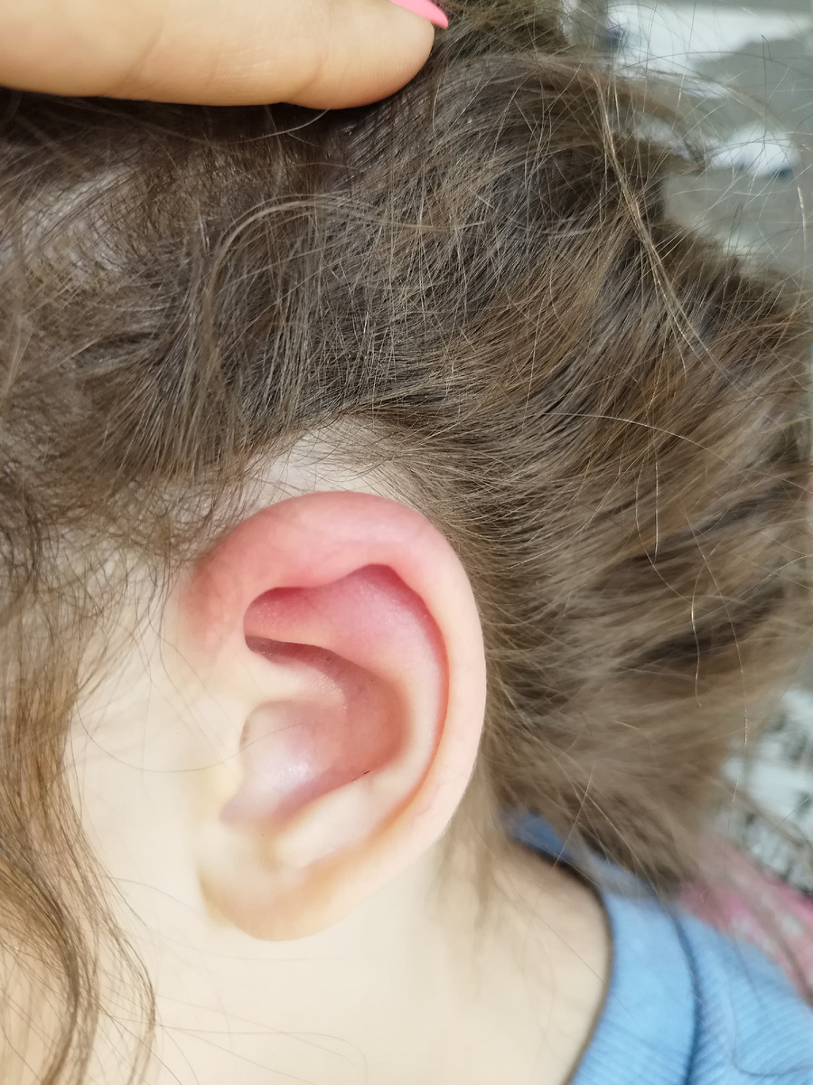 Место, где был клещ. Во время его посещения, мысли и времени сфотографировать небыло.